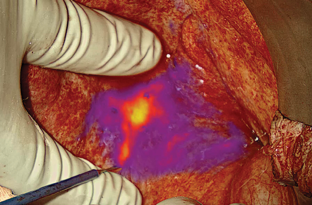 Cancer cells glowing on a tumor during a surgery